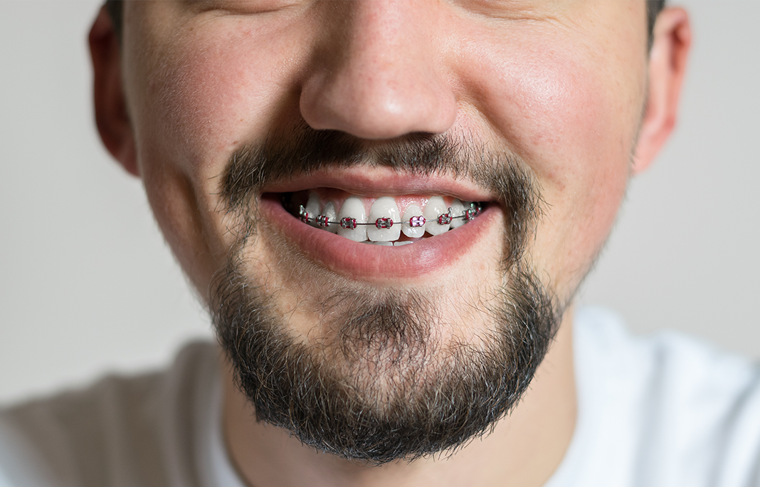 Braces For Adults When Are You Too Old For Treatment 